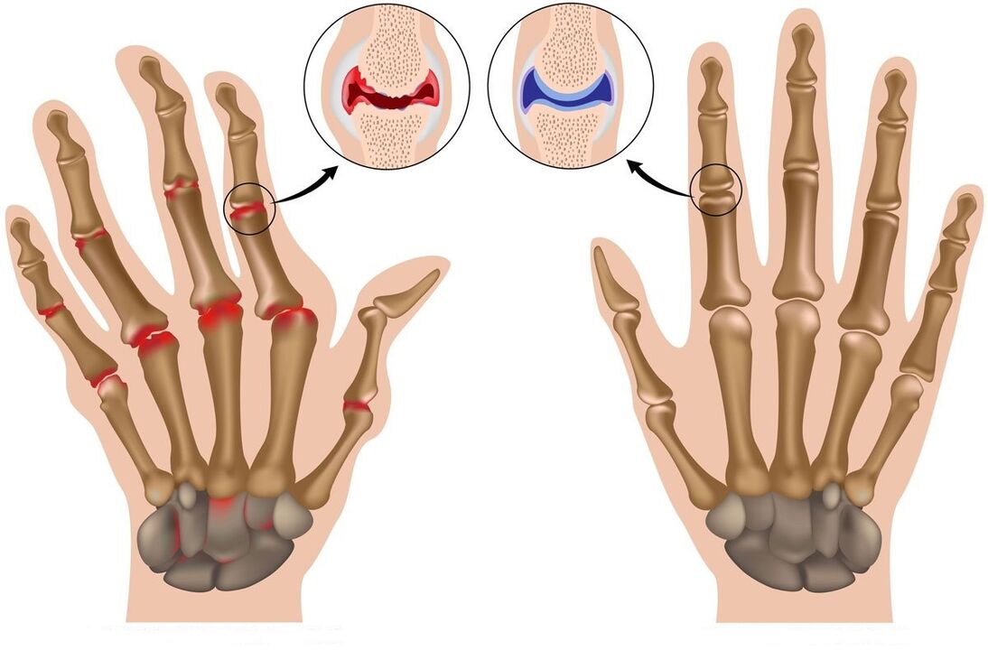 Hondrolife restores the joints