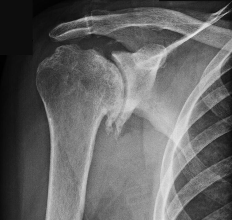 X-ray showed shoulder osteoarthritis