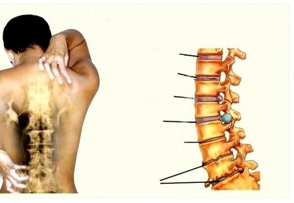 Phase of cervical osteochondosis