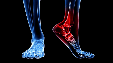 Arthrosis of the ankle joint