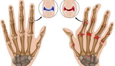 The main differences in arthritis and arthrosis