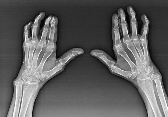 Diagnostics of the joints of the fingers