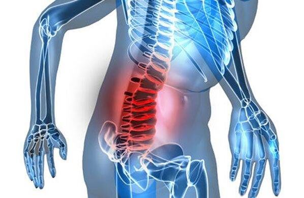 Spinal deformity at the fourth stage of lumbar osteochondrosis