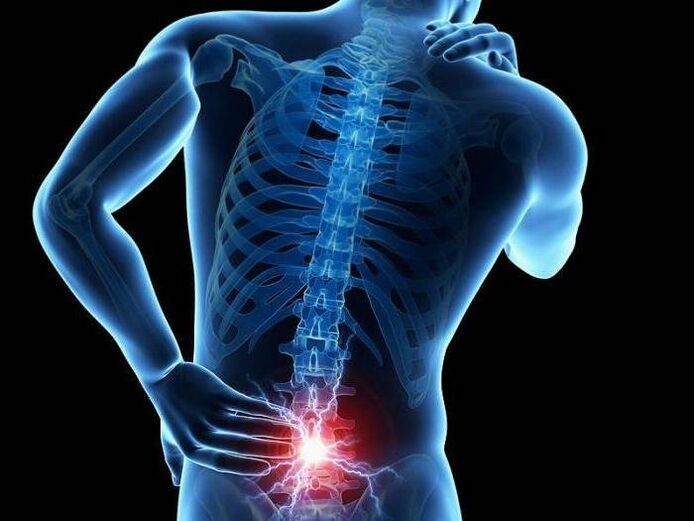 With radiculitis, pinched nerve roots cause a sharp pain to appear in the lower back