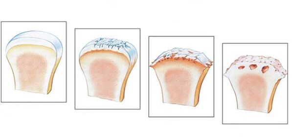 Healthy joint and 3 degrees of development of arthrosis